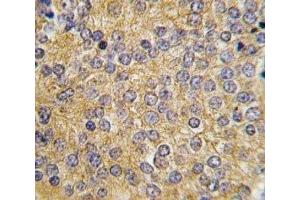 IHC analysis of FFPE human prostate carcinoma tissue stained with Urokinase antibody (PLAU Antikörper  (AA 60-90))