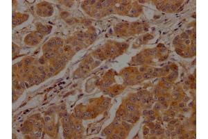 IHC image of ABIN7147846 diluted at 1:200 and staining in paraffin-embedded human breast cancer performed on a Leica BondTM system. (Clathrin Heavy Chain (CLTC) (AA 851-990) Antikörper)