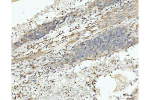 IHC analysis of MT-ND5 using anti-MT-ND5 antibody (ABIN7600145). (MT-ND5 Antikörper  (AA 154-570))