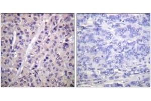 Immunohistochemistry analysis of paraffin-embedded human breast carcinoma, using A-RAF (Phospho-Tyr302) Antibody. (ARAF Antikörper  (pTyr302))