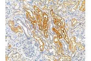 ABIN6259060 and ABIN6274811 at 1/100 staining Human kidney cancer and adjacent normal tissues by IHC-P.