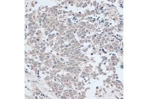Immunohistochemistry of paraffin-embedded human lung cancer using ZNF581 antibody (ABIN6128960, ABIN6150520, ABIN6150521 and ABIN6217055) at dilution of 1:100 (40x lens).