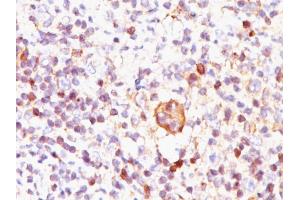Formalin-fixed, paraffin-embedded Hodgkin's lymphoma stained with Bcl-x Mouse Monoclonal Antibody (BX006). (BCL2L1 Antikörper  (AA 3-14))