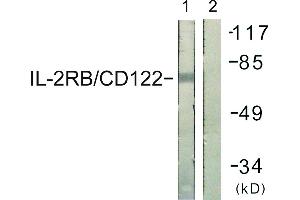Immunohistochemistry analysis of paraffin-embedded human lung carcinoma tissue using IL-2Rβ/CD122 (Ab-364) antibody. (IL2 Receptor beta Antikörper)