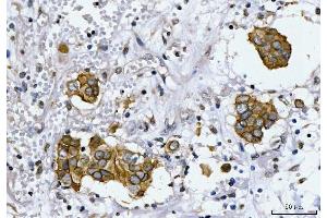 IHC analysis of HER2/ERBB2 using anti-HER2/ERBB2 antibody (ABIN7600737). (ErbB2/Her2 Antikörper  (AA 23-193))