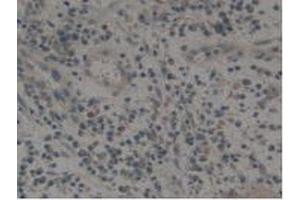 IHC-P analysis of Human Skin Cancer Tissue, with DAB staining. (Tissue factor Antikörper  (AA 34-251))