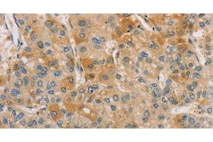 Immunohistochemistry of paraffin-embedded Human liver cancer tissue using CENPF Polyclonal Antibody at dilution 1:40 (CENPF Antikörper)