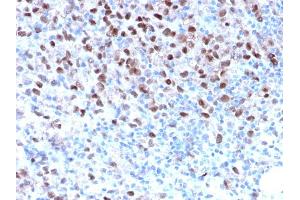 Formalin-fixed, paraffin-embedded human Melanoma stained with MITF Recombinant Rabbit Monoclonal Antibody (MITF/2987R). (Rekombinanter MITF Antikörper)