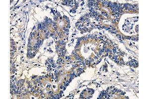 ABIN7095031 and ABIN7099087 at 1/100 staining human colorectal cancer by IHC-P. (SRGAP2 Antikörper)