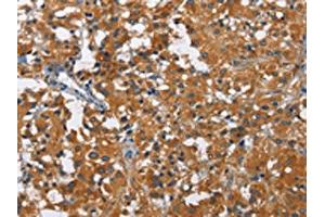 The image on the left is immunohistochemistry of paraffin-embedded Human thyroid cancer tissue using ABIN7130004(KLF7 Antibody) at dilution 1/60, on the right is treated with fusion protein.