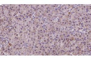 ABIN6273219 at 1/100 staining Human pancreas cancer tissue by IHC-P. (CTNNA3 Antikörper  (Internal Region))