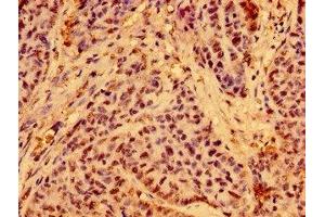 Immunohistochemistry of paraffin-embedded human ovarian cancer using ABIN7165166 at dilution of 1:100 (C19ORF12 Antikörper  (AA 65-104))