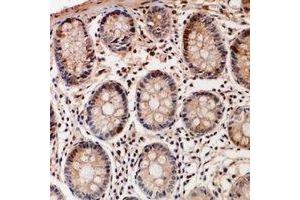 Immunohistochemical analysis of TSSK6 staining in human colon cancer formalin fixed paraffin embedded tissue section.