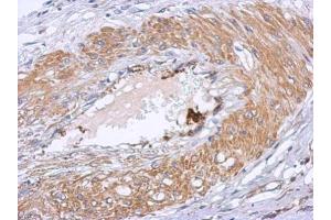IHC-P Image Immunohistochemical analysis of paraffin-embedded human gastric cancer, using Dystrobrevin beta, antibody at 1:500 dilution.