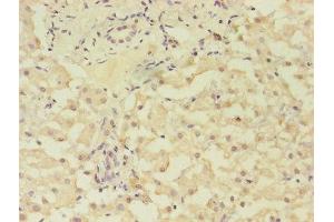 Immunohistochemistry of paraffin-embedded human liver cancer using ABIN7153293 at dilution of 1:100 (GRK4 Antikörper  (AA 1-245))