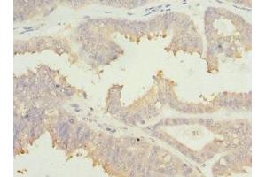 Immunohistochemistry of paraffin-embedded human prostate cancer using ABIN7172902 at dilution of 1:100 (EIF2B1 Antikörper  (AA 1-305))