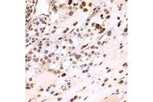 Immunohistochemistry of paraffin-embedded human kidney cancer using CEBPG antibody (ABIN5974381) at dilution of 1/100 (40x lens). (CEBPG Antikörper)