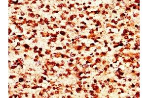 IHC image of nforHU diluted at 1:50 and staining in paraffin-embedded human glioma performed on a Leica BondTM system. (HIST1H1C Antikörper)