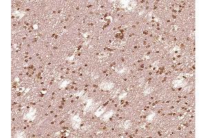 Paraformaldehyde-fixed, paraffin embedded Human brain glioma Antigen retrieval by boiling in sodium citrate buffer (pH6.