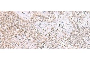 Immunohistochemistry of paraffin-embedded Human ovarian cancer tissue using SMNDC1 Polyclonal Antibody at dilution of 1:50(x200)