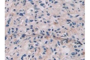 Detection of IL12A in Human Prostate cancer Tissue using Monoclonal Antibody to Interleukin 12A (IL12A) (IL12A Antikörper  (AA 23-219))