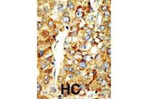 Formalin-fixed and paraffin-embedded human hepatocellular carcinoma tissue reacted with the SETD8 polyclonal antibody  , which was peroxidase-conjugated to the secondary antibody, followed by DAB staining. (SETD8 Antikörper  (AA 25-53))