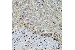 Immunohistochemistry of paraffin-embedded human liver injury using S100A12 antibody. (S100A12 Antikörper  (AA 1-92))