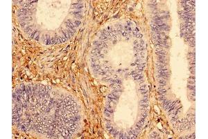 Immunohistochemistry of paraffin-embedded human colon cancer using ABIN7173954 at dilution of 1:100