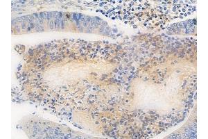 ABIN6264879 and ABIN6272562 at 1/100 staining human colon carcinoma by IHC-P. (RTDR1 Antikörper  (Internal Region))
