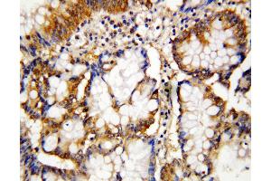 Anti-Caspase-10 antibody, IHC(P) IHC(P): Human Intestinal Cancer Tissue
