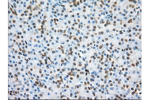Immunohistochemical staining of paraffin-embedded Adenocarcinoma of Human colon tissue using anti-PDE4A mouse monoclonal antibody. (PDE4A Antikörper)
