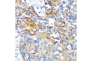 Immunohistochemistry of paraffin-embedded Human lung cancer using KIF17 Rabbit pAb (ABIN7268123) at dilution of 1:100 (40x lens). (KIF17 Antikörper  (AA 360-660))