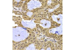 Immunohistochemistry of paraffin-embedded human oophoroma using XPO5 antibody at dilution of 1:100 (x400 lens). (XPO5 Antikörper)