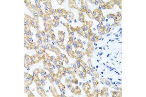 Immunohistochemistry of paraffin-embedded human liver injury using RIPK4 antibody. (RIPK4 Antikörper  (AA 240-520))