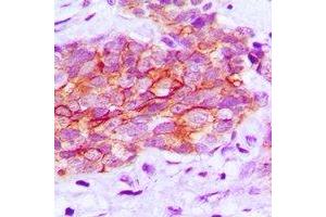 Immunohistochemical analysis of EGFR (pY1016) staining in human prostate cancer formalin fixed paraffin embedded tissue section.