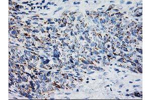 Immunohistochemical staining of paraffin-embedded Adenocarcinoma of Human colon tissue using anti-XPNPEP3 mouse monoclonal antibody. (XPNPEP3 Antikörper)