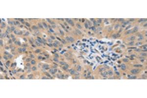 Immunohistochemistry of paraffin-embedded Human ovarian cancer tissue using P2RY6 Polyclonal Antibody at dilution of 1:40(x200) (P2RY6 Antikörper)