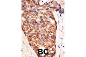Formalin-fixed and paraffin-embedded human cancer tissue reacted with XIAP polyclonal antibody  , which was peroxidase-conjugated to the secondary antibody, followed by AEC staining. (XIAP Antikörper  (N-Term))