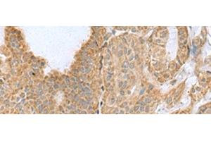 Immunohistochemistry of paraffin-embedded Human thyroid cancer tissue using CSRP2 Polyclonal Antibody at dilution of 1:60(x200) (CSRP2 Antikörper)