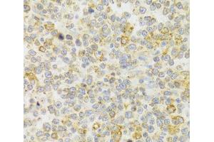Immunohistochemistry of paraffin-embedded Human B cell lymphoma using KISS1R Polyclonal Antibody at dilution of 1:100 (40x lens). (KISS1R Antikörper)