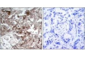 Immunohistochemistry analysis of paraffin-embedded human breast carcinoma tissue, using Cortactin (Ab-466) Antibody. (Cortactin Antikörper  (AA 441-490))