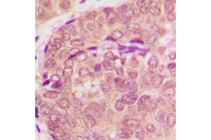 Immunohistochemical analysis of STAT6 staining in human breast cancer formalin fixed paraffin embedded tissue section.