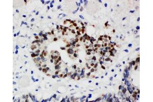 Anti-Nucleophosmin antibody, IHC(P) IHC(P): Human Intestinal Cancer Tissue (NPM1 Antikörper  (N-Term))