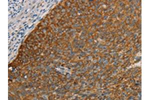 The image on the left is immunohistochemistry of paraffin-embedded Human cervical cancer tissue using ABIN7190690(FOXF2 Antibody) at dilution 1/30, on the right is treated with synthetic peptide. (FOXF2 Antikörper)