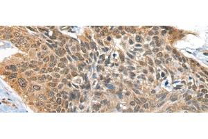 Immunohistochemistry of paraffin-embedded Human esophagus cancer tissue using BOLA1 Polyclonal Antibody at dilution of 1:35(x200) (BOLA1 Antikörper)