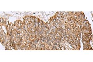 Immunohistochemistry of paraffin-embedded Human colorectal cancer tissue using HCCS Polyclonal Antibody at dilution of 1:110(x200) (HCCS Antikörper)