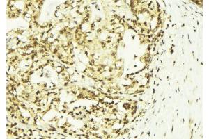 ABIN6273143 at 1/100 staining Human breast cancer tissue by IHC-P. (SSNA1 Antikörper  (N-Term))