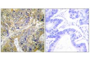Immunohistochemistry analysis of paraffin-embedded human colon carcinoma tissue, using ES8L3 antibody. (EPS8-Like 3 Antikörper  (Internal Region))