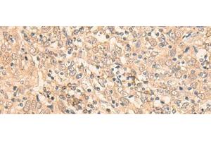 Immunohistochemistry of paraffin-embedded Human cervical cancer tissue using EIF2B5 Polyclonal Antibody at dilution of 1:25(x200) (EIF2B5 Antikörper)