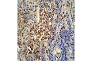 Formalin fixed, paraffin embedded human lung carcinoma stained with PUS3 Antibody (N-term) followed by peroxidase conjugation of the secondary antibody and DAB staining. (PUS3 Antikörper  (N-Term))
